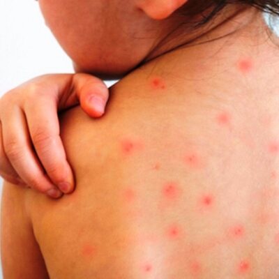 अमेरिकामा दादुराको प्रकोप, बालबालिका बढी प्रभावित