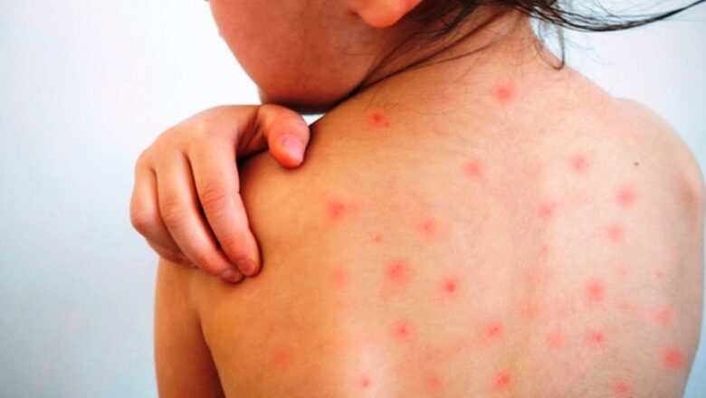 अमेरिकामा दादुराको प्रकोप, बालबालिका बढी प्रभावित